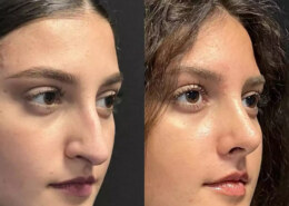 Best Rhinoplasty Surgeon in Dubai for Male & Female Noses
