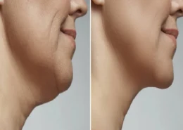 Non-Surgical Fat Removal in Dubai & Abu Dhabi | Glamorous Clinic in Dubai