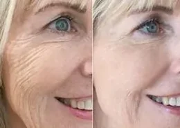 Anti-Aging Skin Treatments with Skin Booster Injections in Dubai & Abu Dhabi – Glamorous Clinic in Dubai